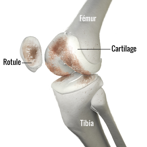 Arthrose du genou - Douleur d'arthrose au genou